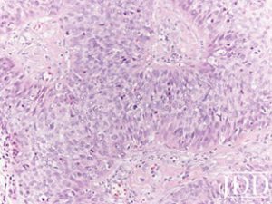 Rapidly Enlarging Malignant Proliferating Trichilemmal Tumor - Next ...