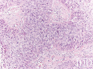 Poorly differentiated deeper component of tumor with atypical mitoses (original magnification x200).