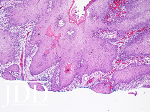 acanthosis with hyperkeratosis