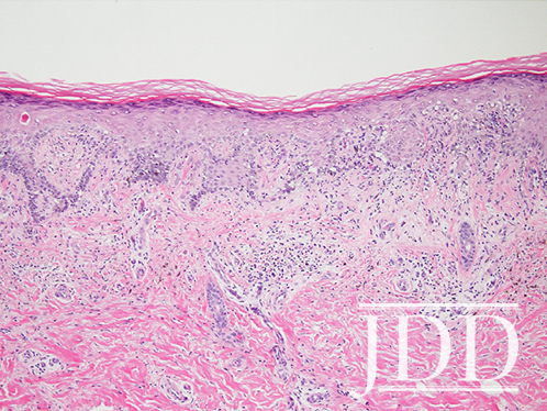 perivascular dermatitis