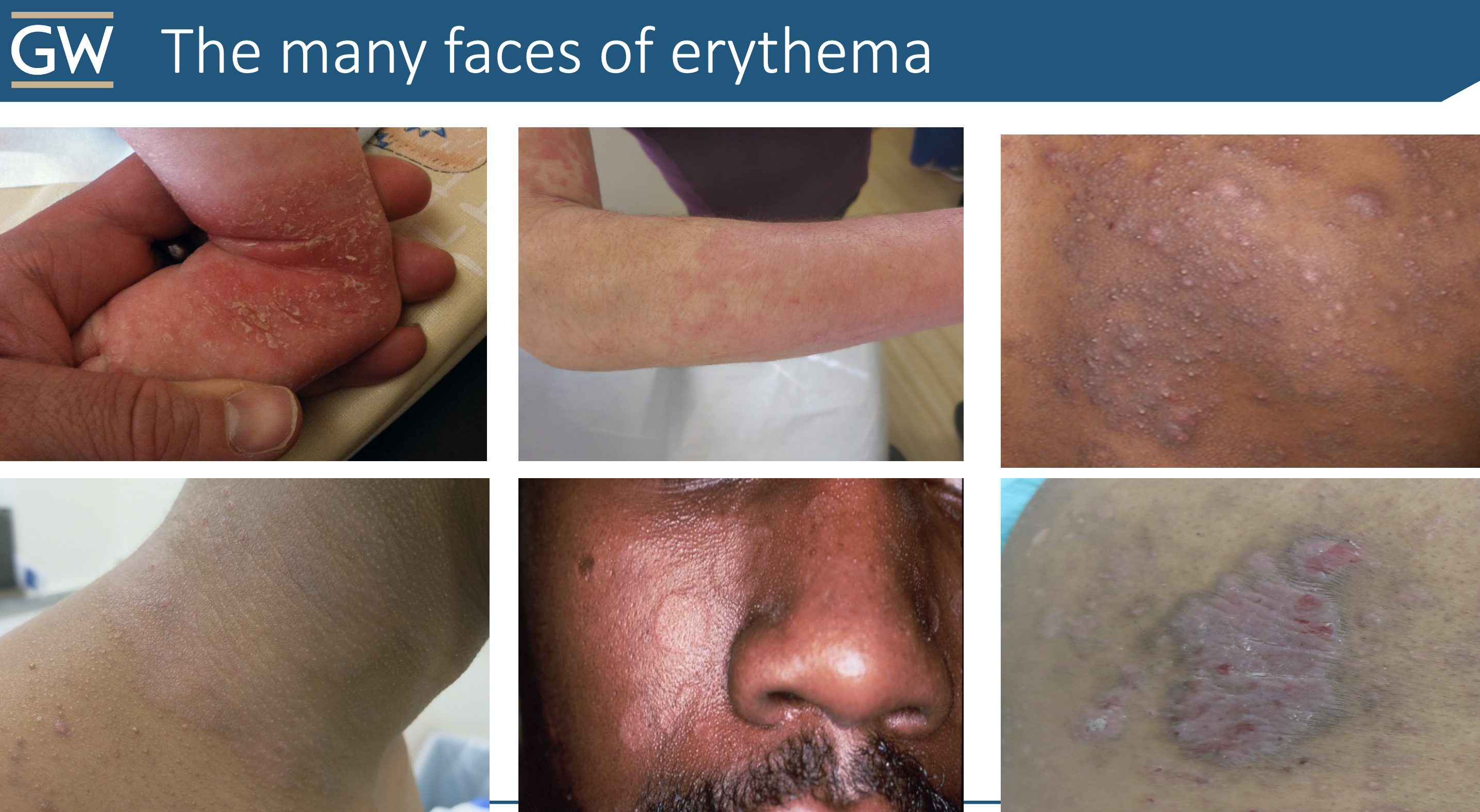 The many faces of erythema