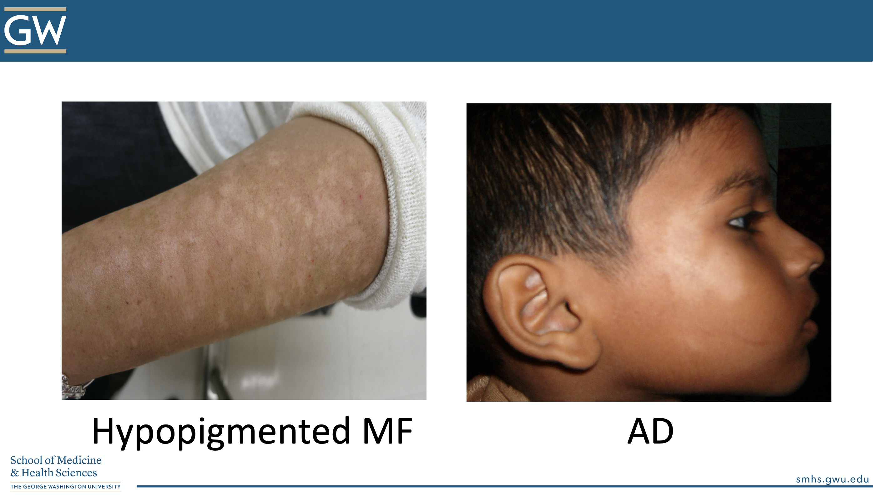 atopic dermatitis