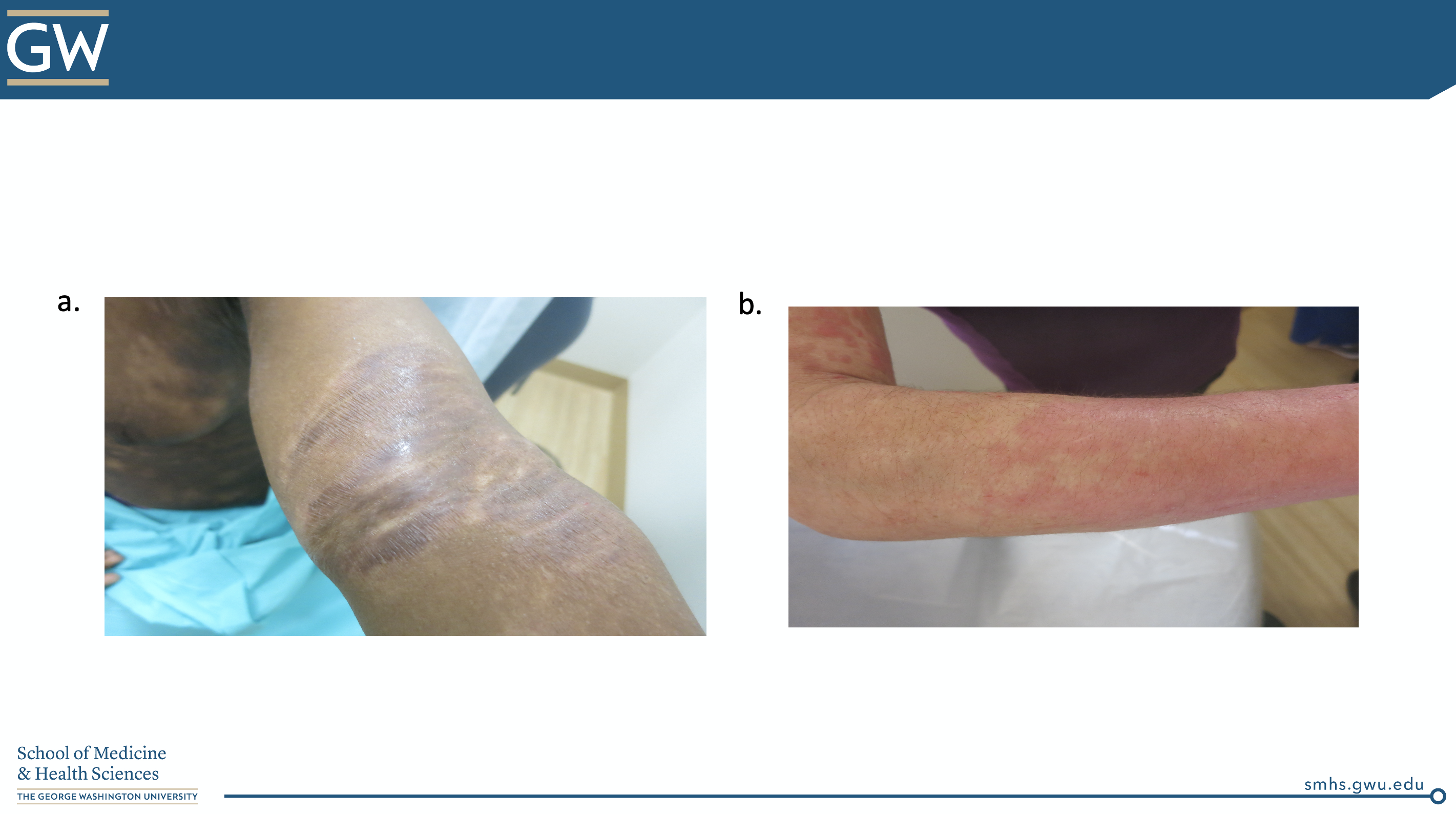 Atopic Dermatitis vs. CTCL