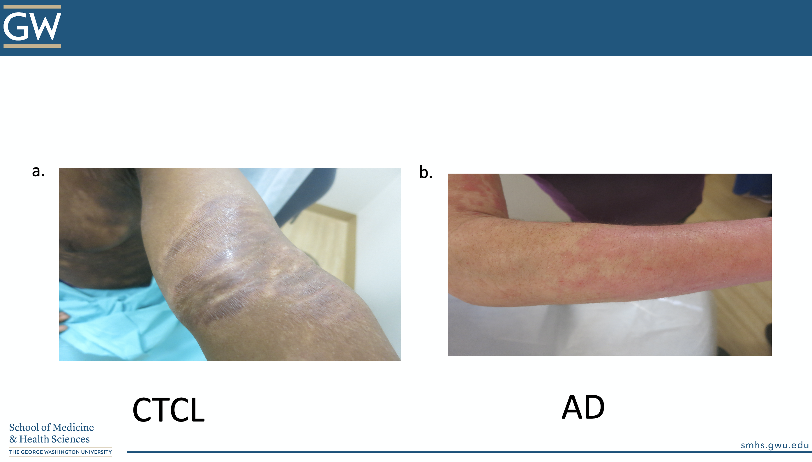 Atopic Dermatitis vs. CTCL