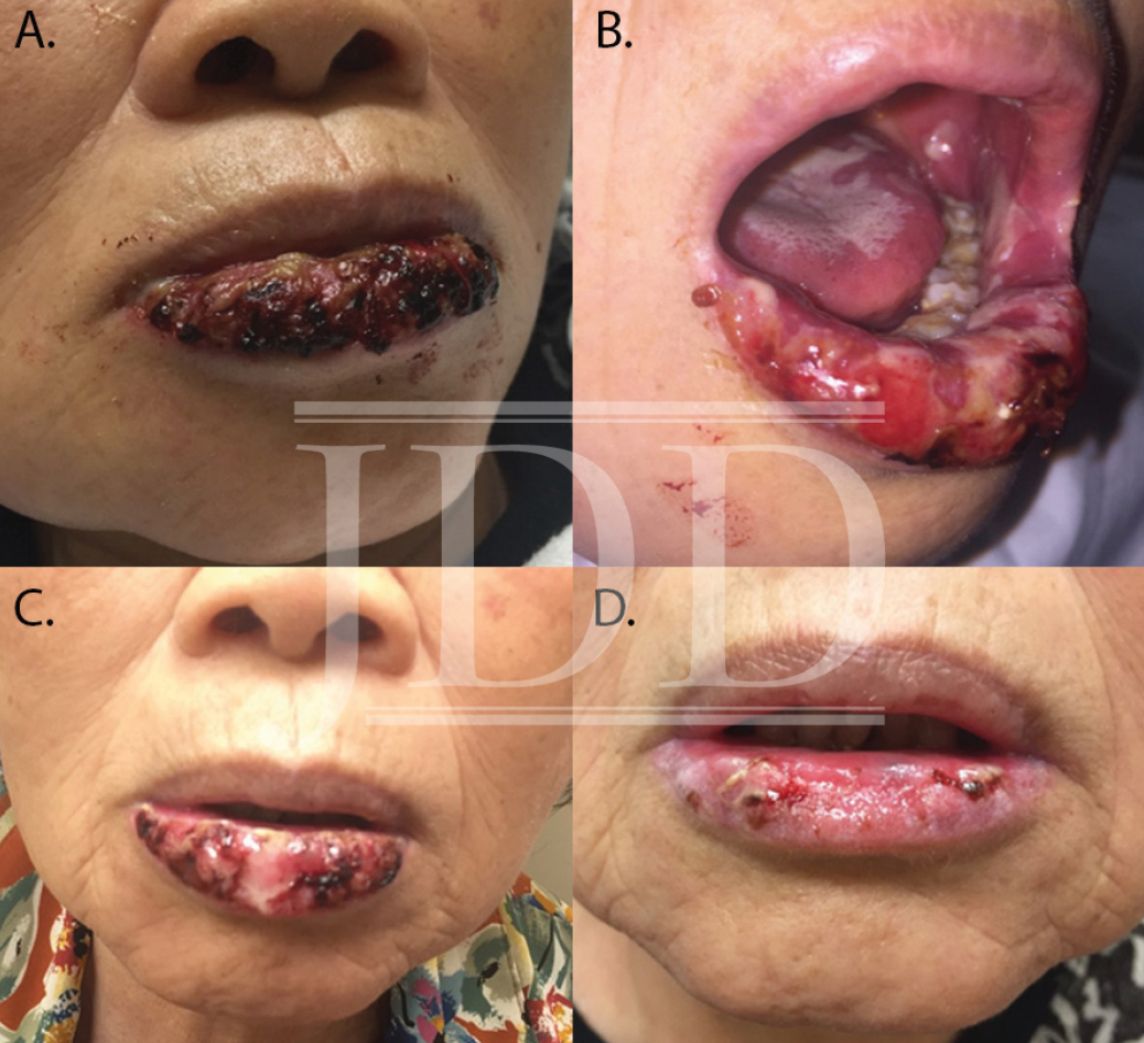 Oral Mucositis