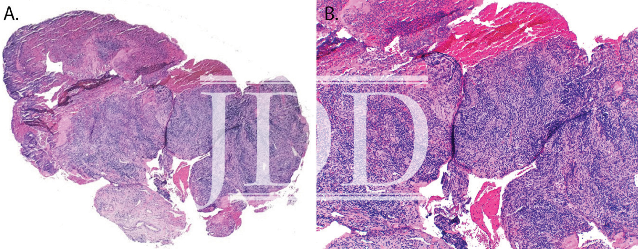 Oral Mucositis