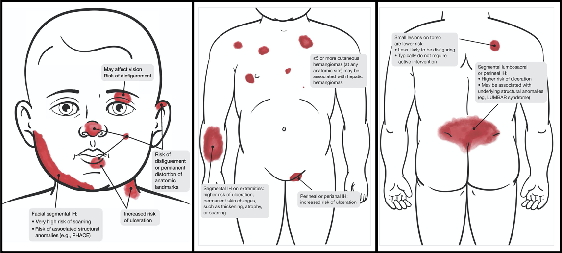 infantile hemangiomas