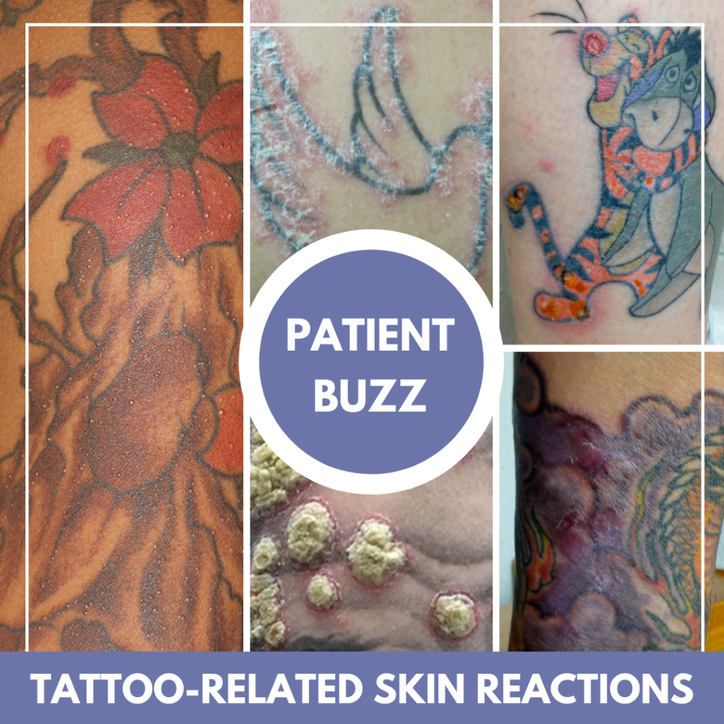 Patient Buzz: Tattoo-Related Skin Reactions - Next Steps in Dermatology