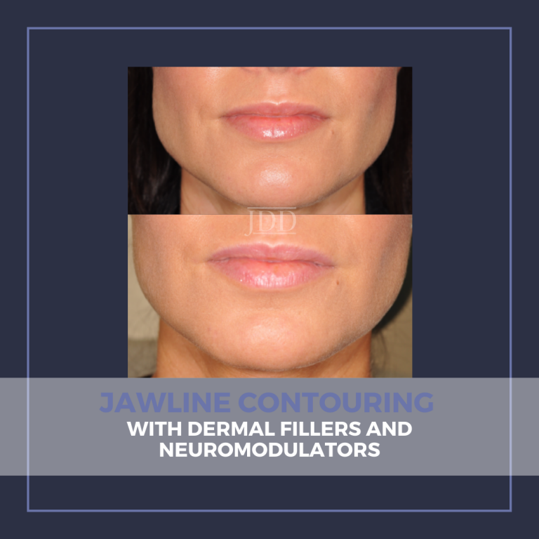 Jawline Contouring with Dermal Fillers and Neuromodulators Next Steps