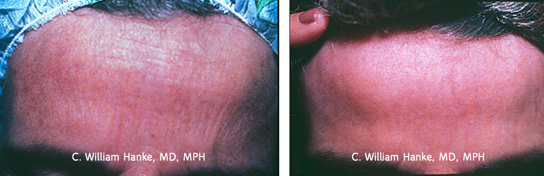 Dermabrasion for actinic damage