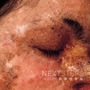 xeroderma pigmentosum