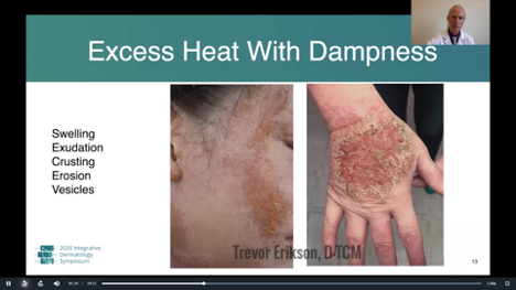 Traditional Chinese Medicine for Atopic Dermatitis