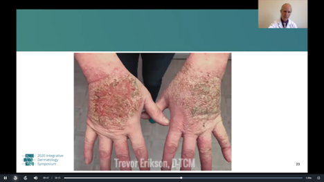 Traditional Chinese Medicine for Atopic Dermatitis