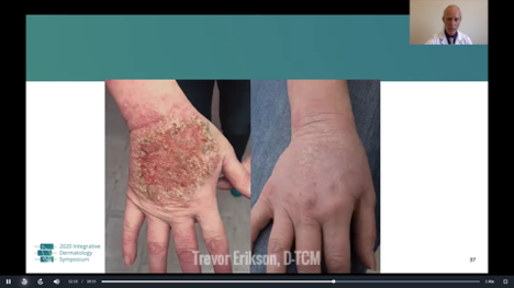 Traditional Chinese Medicine Treatment for Atopic Dermatitis