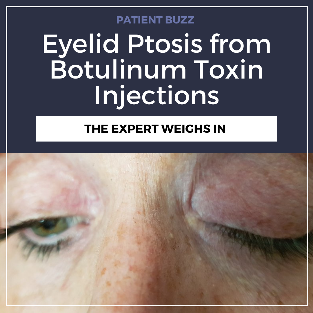 botox side effects droopy eyelid