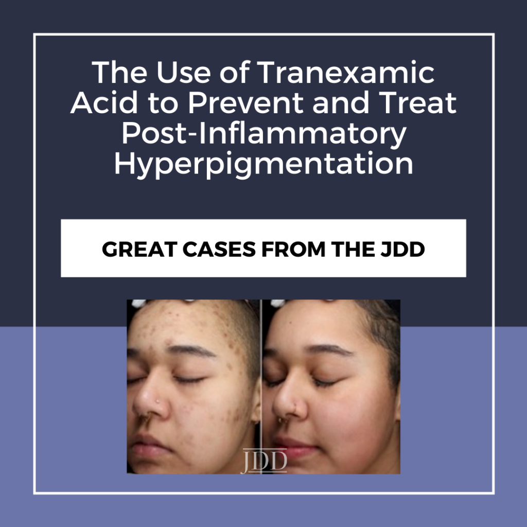 Tranexamic Acid to Prevent and Treat PostInflammatory