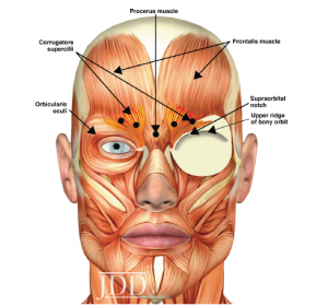 botox side effects droopy eyelid