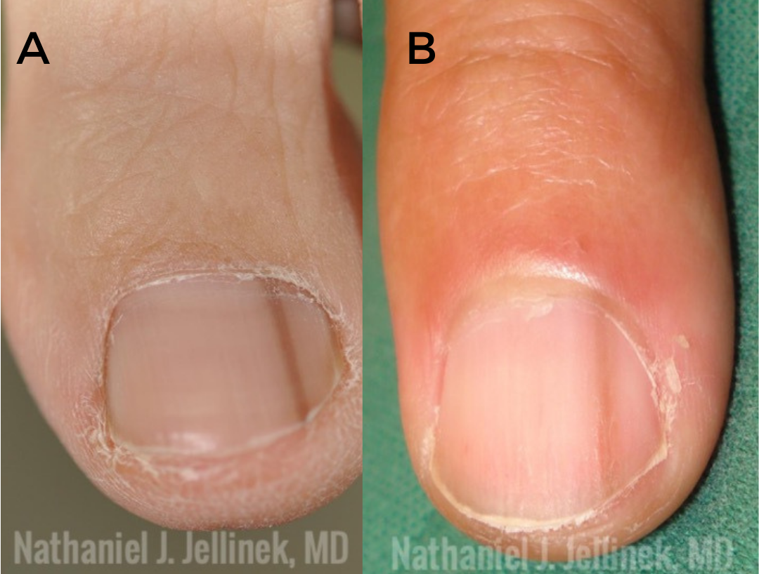 Clinical picture of nail melanoma of the II digit of right hand (A); a... |  Download Scientific Diagram