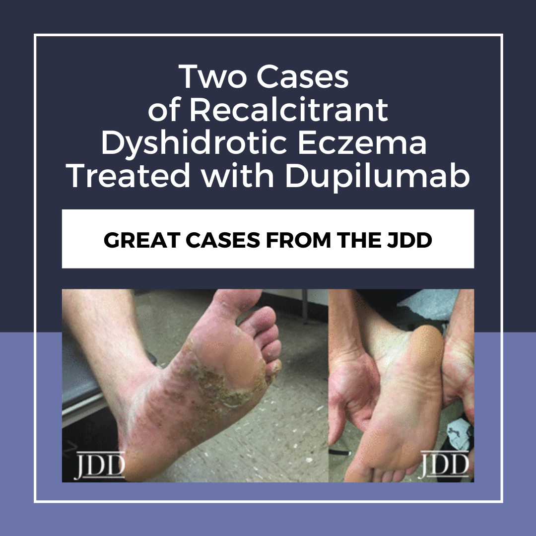 Recalcitrant Dyshidrotic Eczema Treated With Dupilumab Next Steps In Dermatology