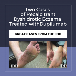 Recalcitrant Dyshidrotic Eczema Treated With Dupilumab