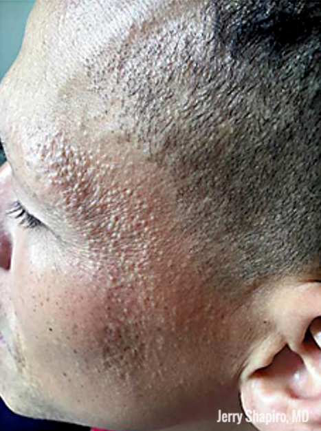 facial papule of frontal fibrosing alopecia (FFA)