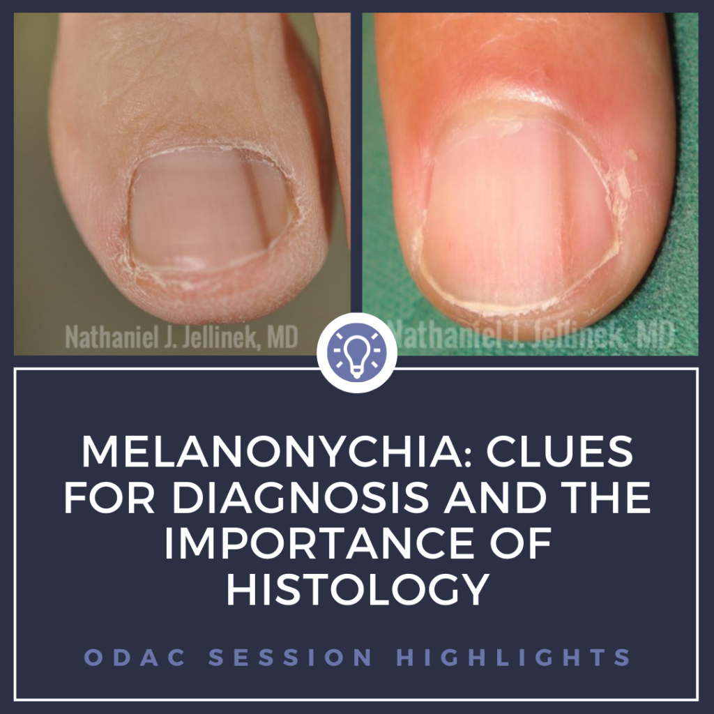 Melanonychia Clues for Diagnosis and the Importance of Histology
