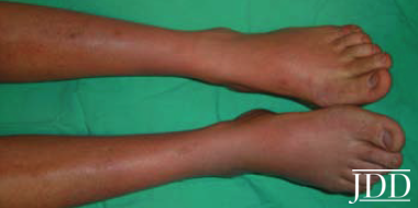 erythromelalgia