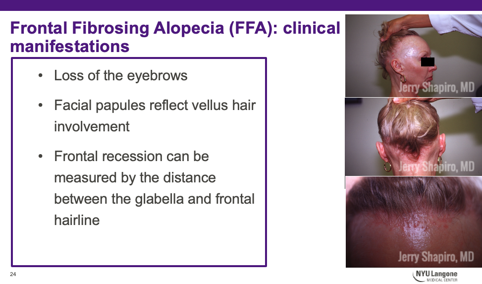 clinical manifestations of Frontal Fibrosing Alopecia (FFA)