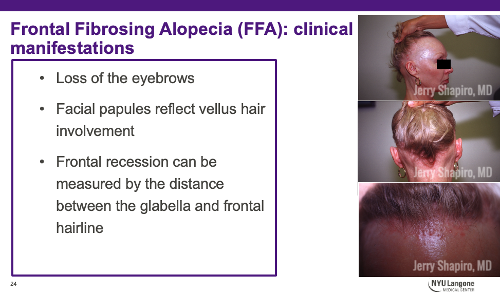 Lichen Planopilaris And Frontal Fibrosing Alopecia Treatment 