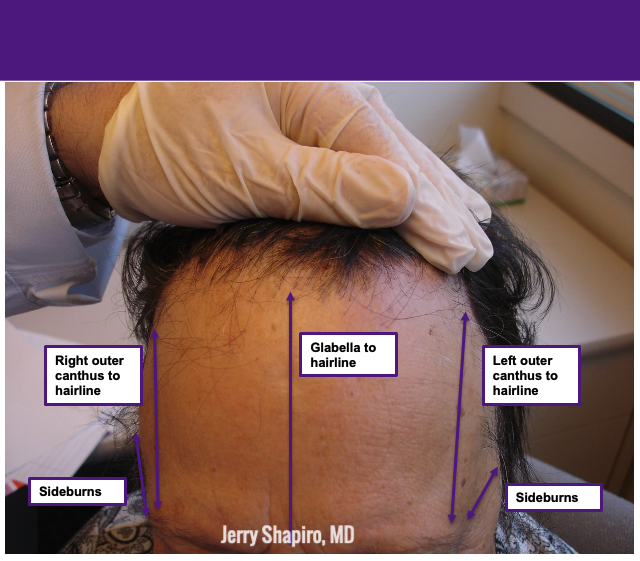 how to measure hair loss in FFA