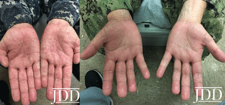 Recalcitrant Dyshidrotic Eczema Treated With Dupilumab