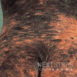congenital melanocytic nevus