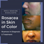 Rosacea in skin of color