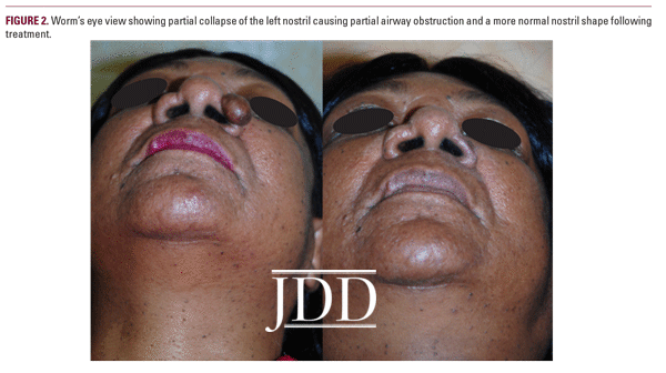 Treatment of Rhinophyma