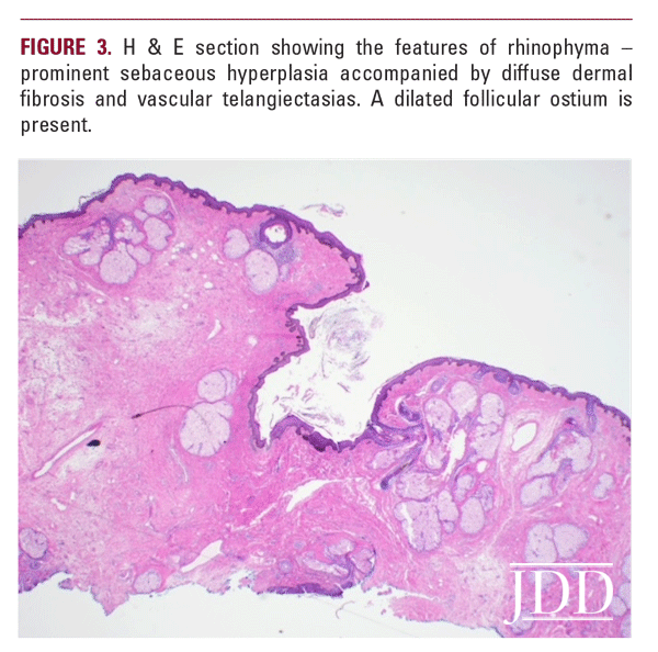 Treatment of Rhinophyma