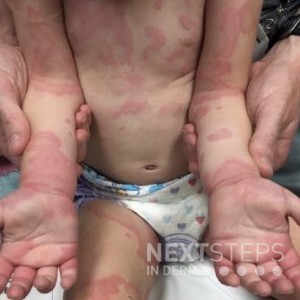 pruritic rash