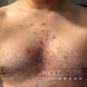 superficial folliculitis