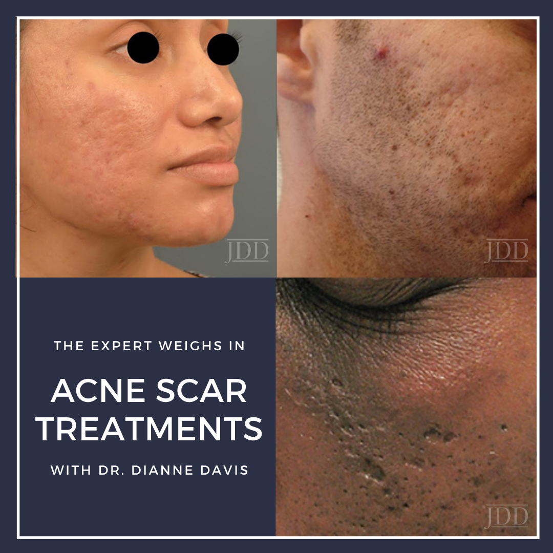 Acne Scar Treatments