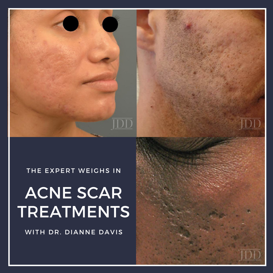 Acnes shop scar care