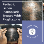 Pediatric Lichen Planopilaris