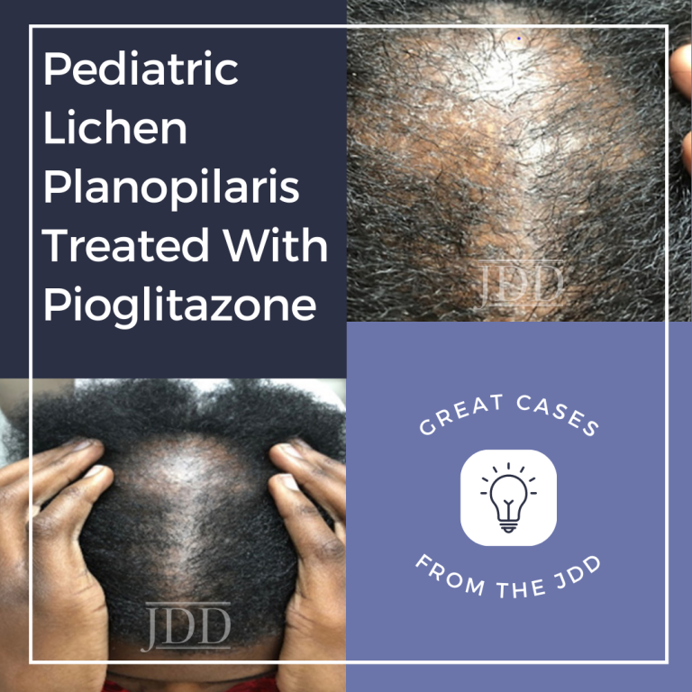 Pediatric Lichen Planopilaris Treated With Pioglitazone Next Steps In 