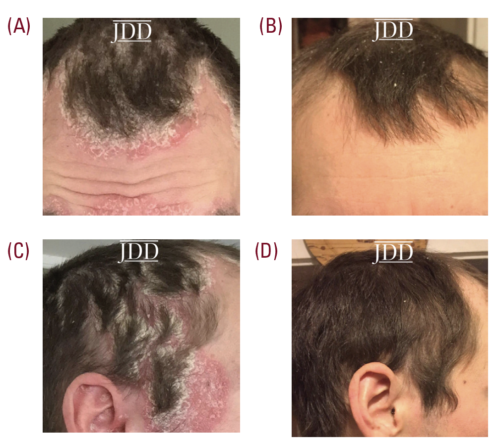 cannabinoids for psoriasis