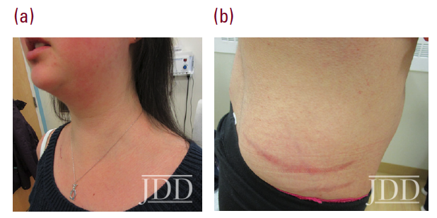 Cushing’s syndrome