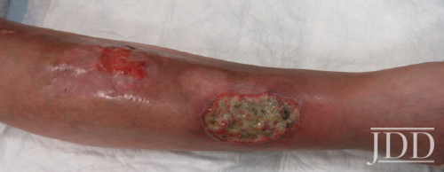 Pyoderma gangrenosum (PG)