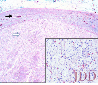 adrenocortical adenoma