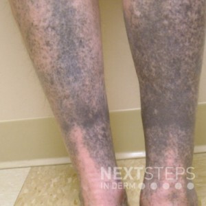 Sock-line Hyperpigmentation: Symptoms, Causes, Prevention