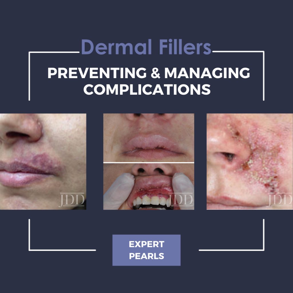 Dermal Filler Injections Preventing Managing Complications Pearls 