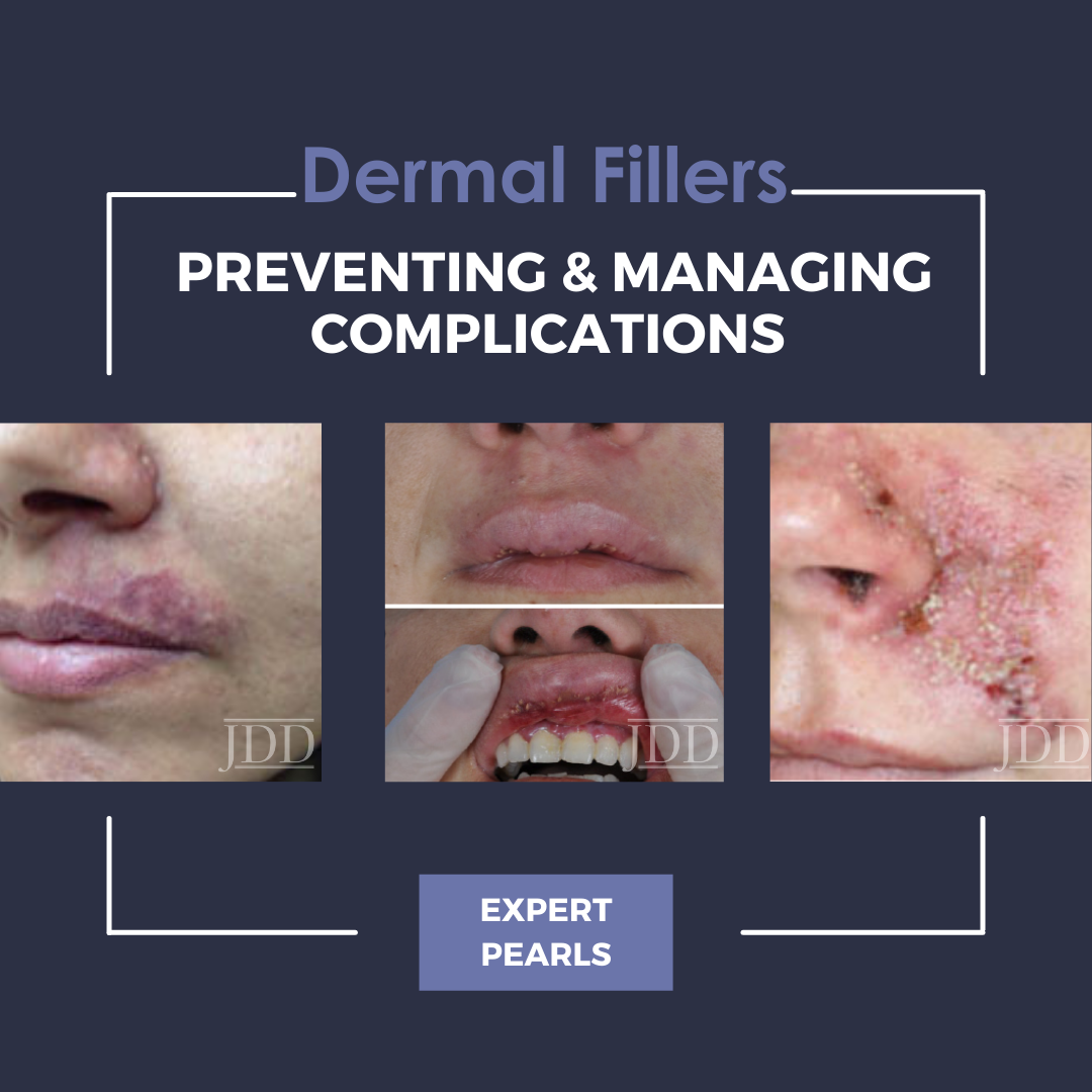 Dermal Filler Injections: Preventing & Managing Complications