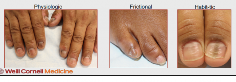 The Art Of Nail Findings In Patients With Skin Of Color - Next Steps In 