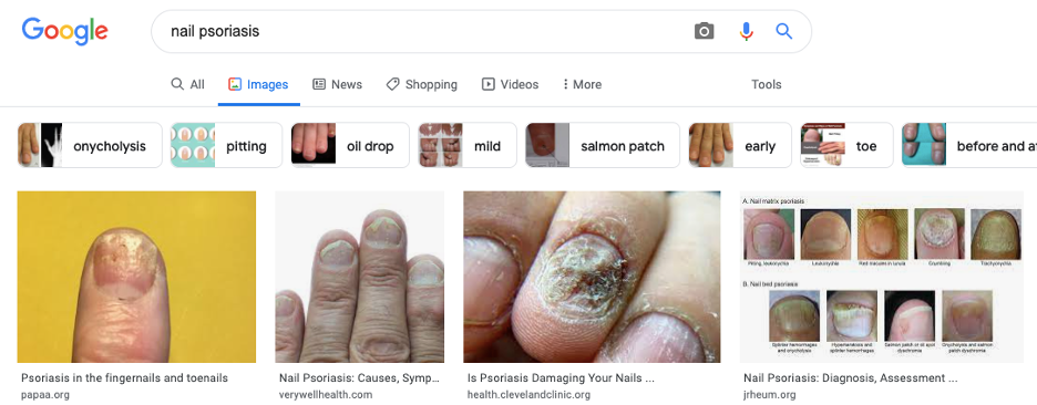 Nail psoriasis google search